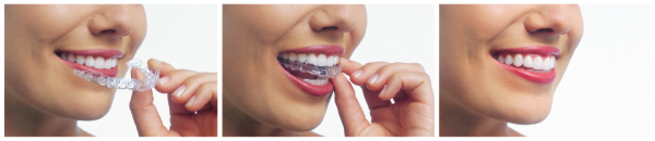 Before and after photo of woman who had Invisalign teeth aligners by her dentist in Wasilla, AK. Before and after photo of woman who had Invisalign teeth aligners by her dentist in Wasilla, AK.